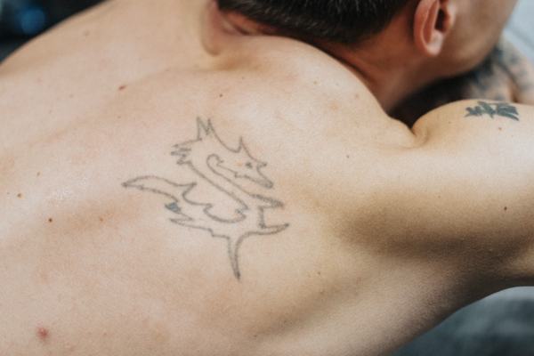 Tatuiruotės šviesinimo rimuveriu procedūra