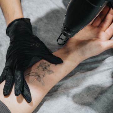 tattoo laser lightening procedure