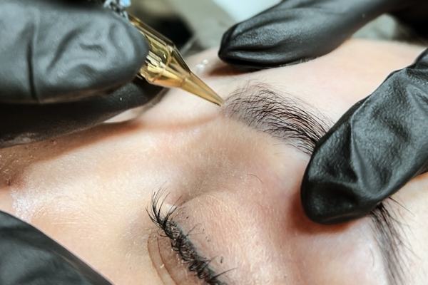 rėmoverio įvedimas į tatuiruotės pigmento zoną