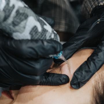 tatuiruotės šviesinimas rimuveriu procedūros metu