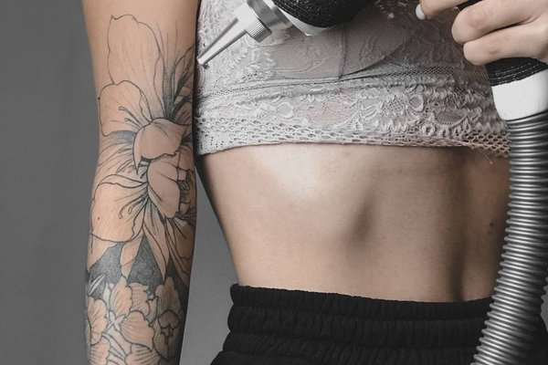 Laser tattoo removal in Kaunas
