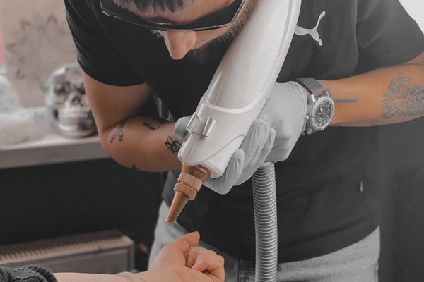 Tattoo removal in Panevezys