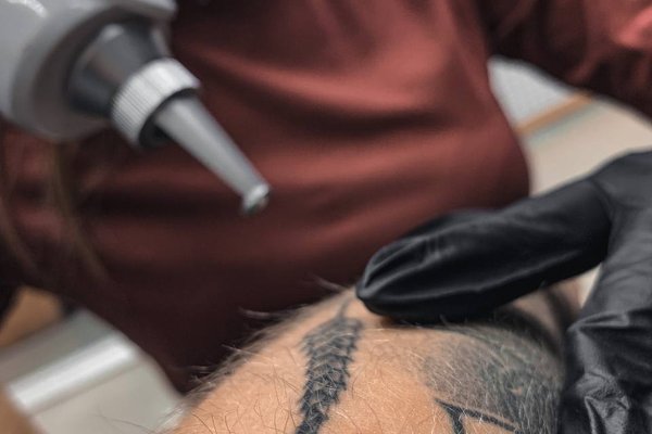 Tattoo removal in Panevezys