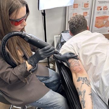 tattoo laser lightening procedure