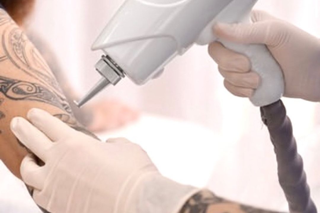 Laser tattoo removal in Kaunas