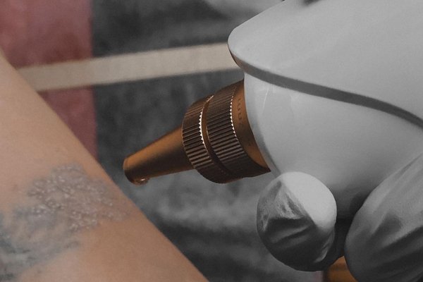 Tattoo Removal in Klaipeda