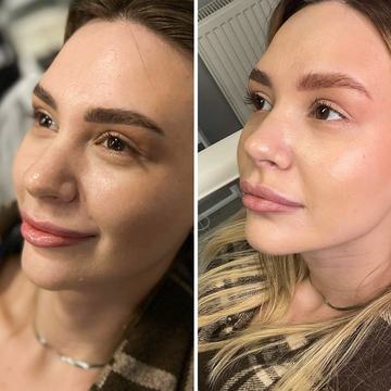 lazerio poveikis tatuiruotės pigmentui odoje