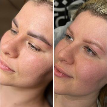 tatuiruotės šviesinimas lazeriu prieš ir po procedūros