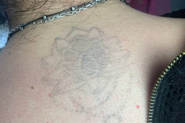 tatuiruočių šviesinimo rėmoveriu mokymai praktikos metu