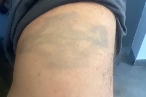 tatuiruočių šviesinimo rėmoveriu mokymai praktikos metu