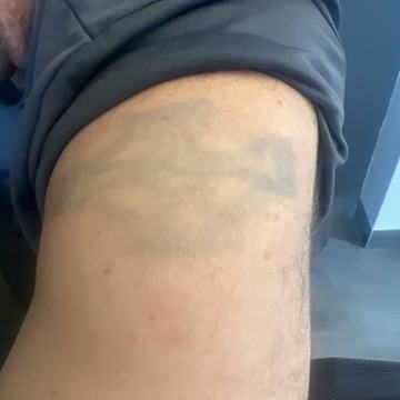 tattoo remover lightening training during practical course