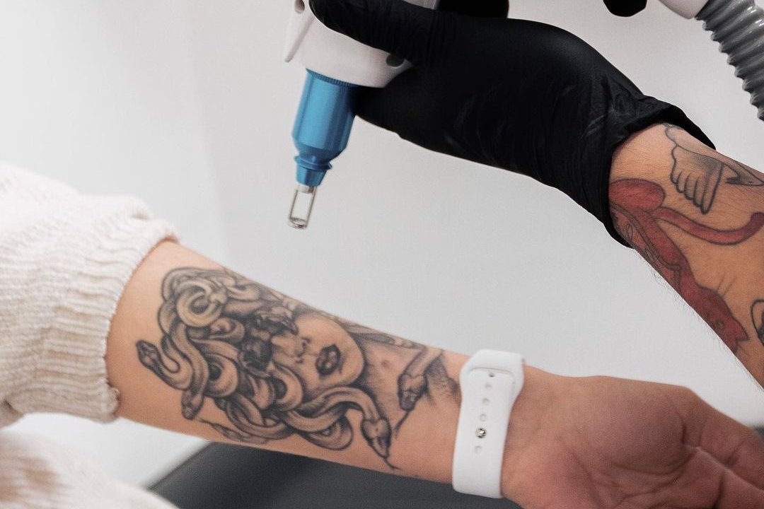 Tatuiruotės šalinimas Kaune