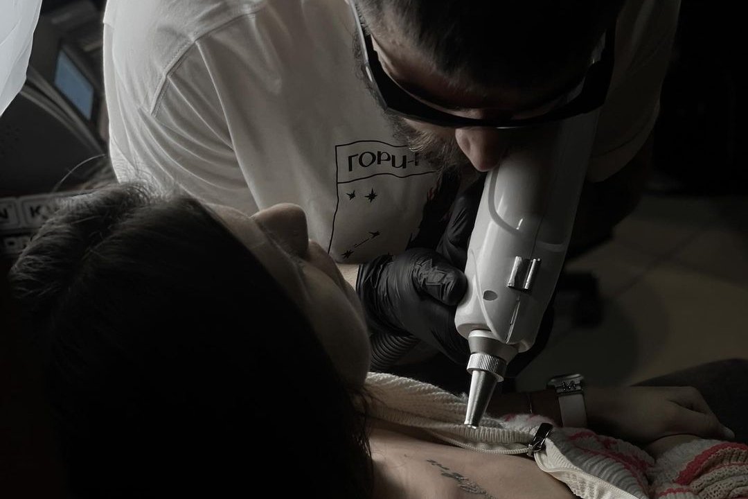 Tatuiruotės šalinimas Klaipėdoje
