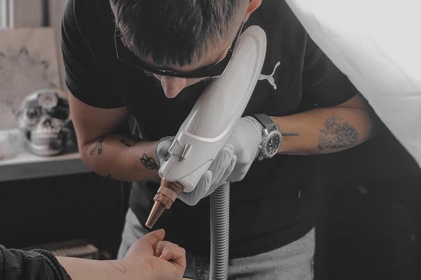 Tatuiruotės šalinimas Kaune